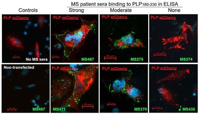 Correlation Between Anti-Myelin Proteolipid Protein (PLP) Antibodies and Disease Severity in Multiple Sclerosis Patients With PLP Response-Permissive HLA Types